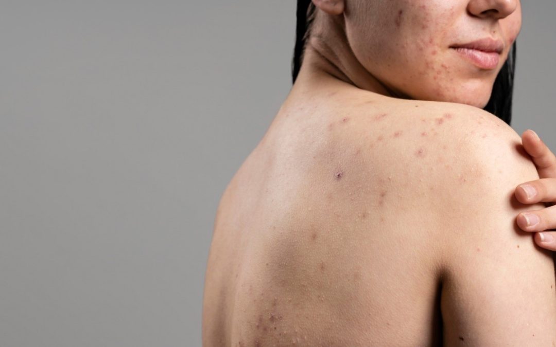 ACNE HORMONAL